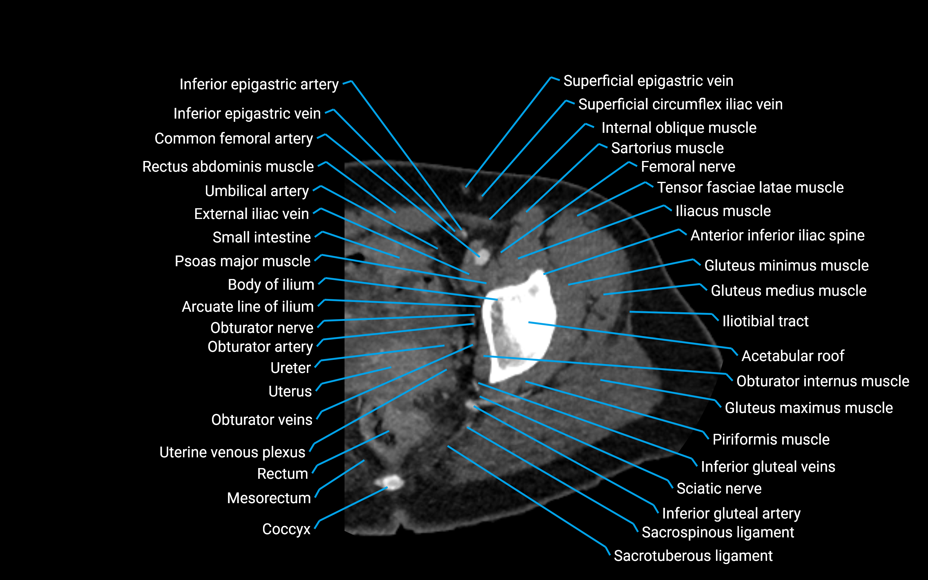 CT Hip axial cross sectional anatomy labelled image 3 (1).png